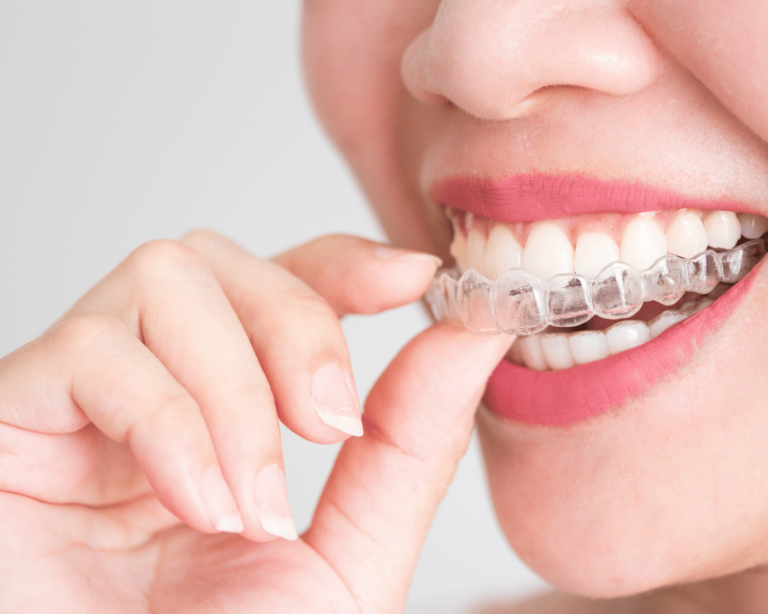 The Evolution of Braces: From Metal Mouth to Modern Marvels