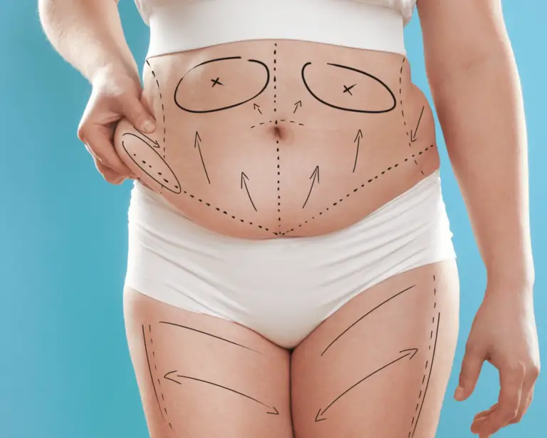 How Long Does a Tummy Tuck Last?