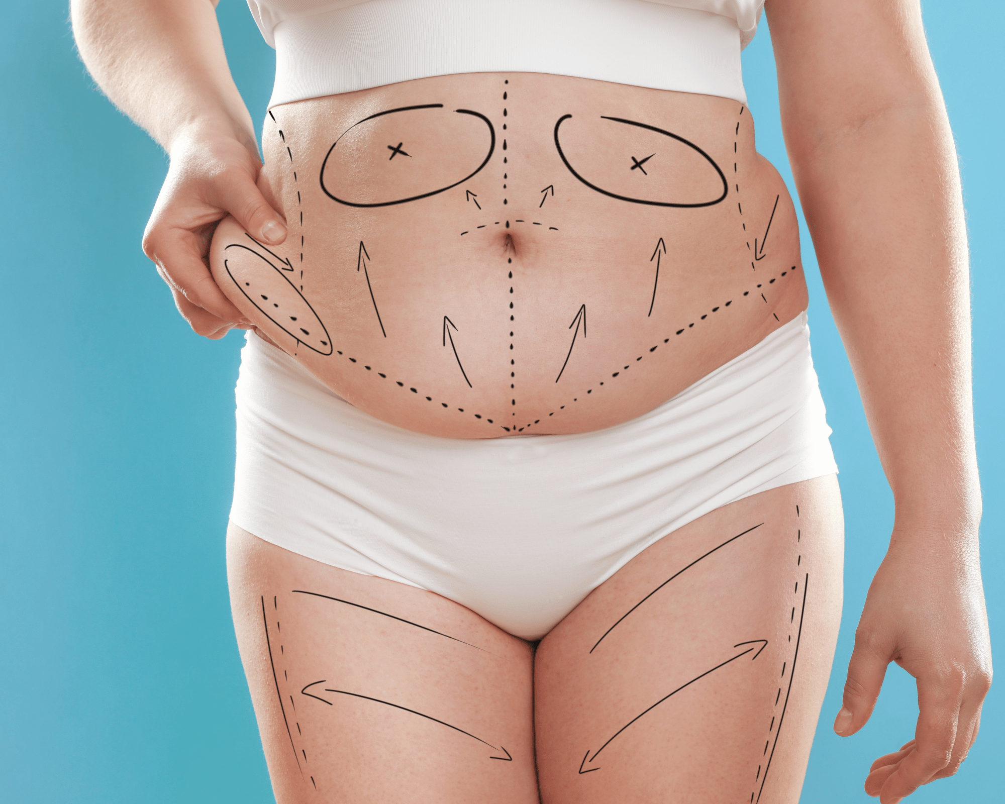 How Long Does a Tummy Tuck Last?